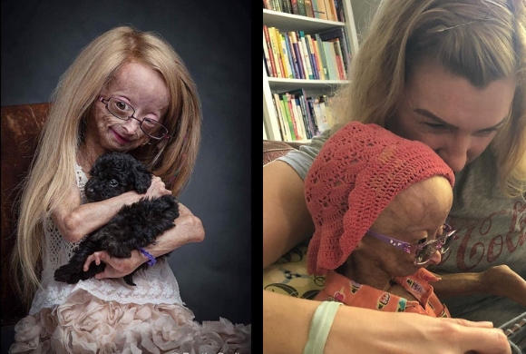 Ma 11 lat i organizm 90-letniej staruszki. Poznajcie dziewczynkę z progerią, którą pokochał świat