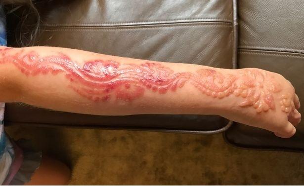 To miał być wakacyjny tatuaż z henny. Dziewczynka trafiła na ostry dyżur z... wypaloną skórą!