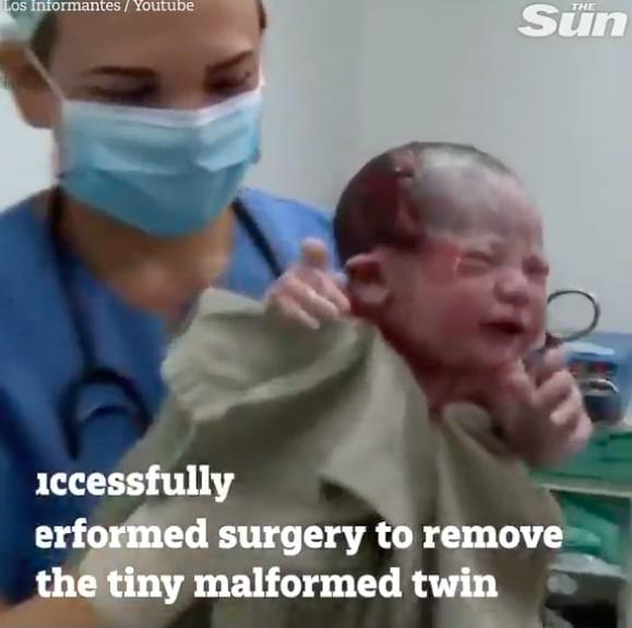 W chwili narodzin ta mała dziewczynka miała w sobie drugi płód!