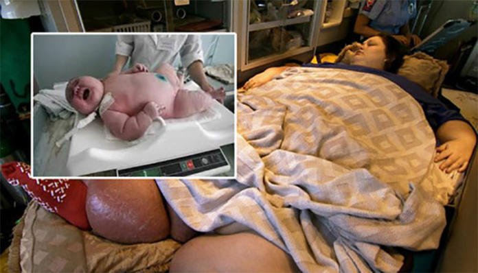 Otyła kobieta urodziła dziecko ważące... 18 kilogramów. Zobacz, jak wygląda "maleństwo".