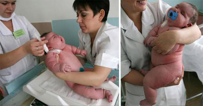 Otyła kobieta urodziła dziecko ważące... 18 kilogramów. Zobacz, jak wygląda "maleństwo".