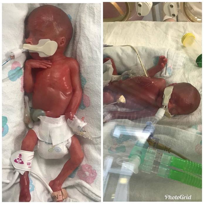 Te bliźnięta urodziły się w 23. tygodniu ciąży. Lekarze są zaskoczeni, że przeżyły